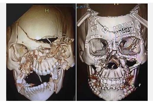 Nevjerovatan podvig: Prije i poslije rekonstrukcije lobanje