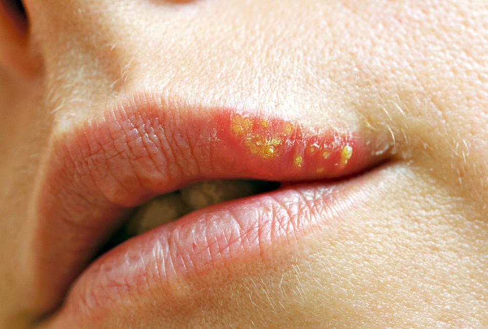 Grupu herpes virusa čine varičela zoster virus i herpes simpleks virus - Avaz