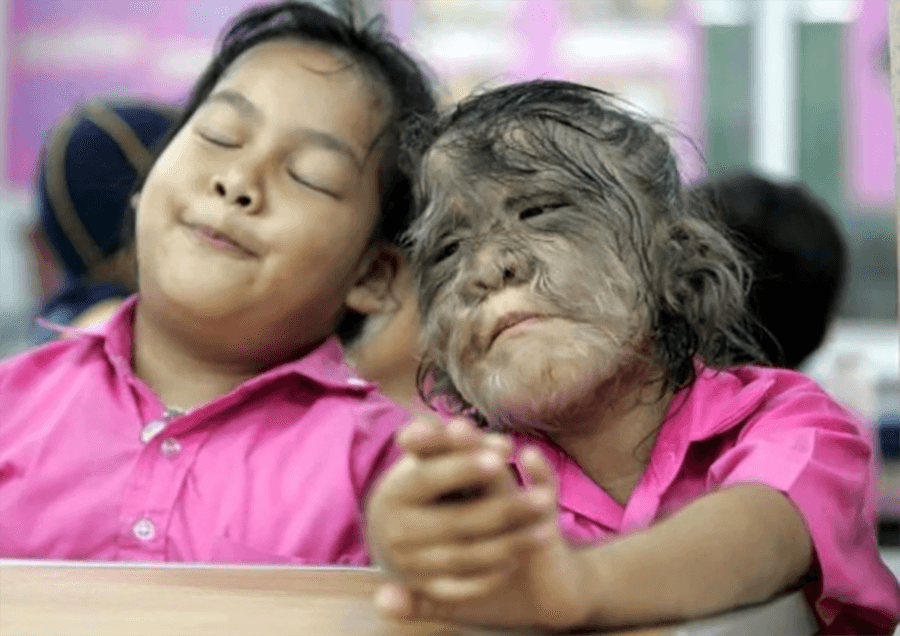 Djeca zbog pogrešne terapije liče na vukodlake