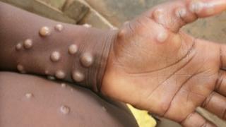 U Belgiji otkrivena nova varijanta virusa Mpox