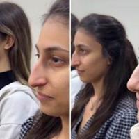 Plastični hirurg iz Turske čini čuda: Pogledajte transformaciju sestara nakon operacije nosa